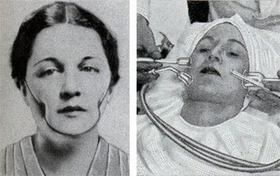 Isabella Gilbert's Dimple Machine from 1936 and a 1932 Suction Treatment for skin-cleaning. Via ModernMechanix.com.